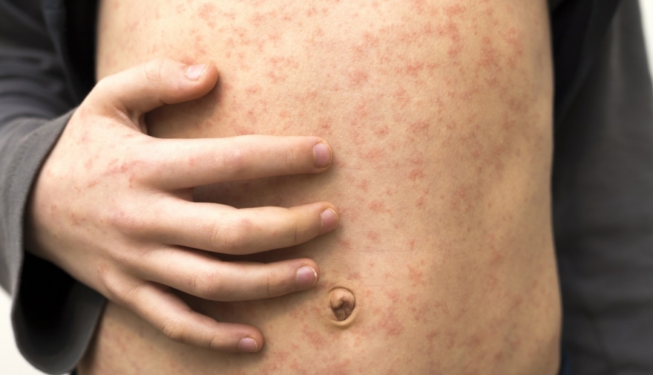 Morbillo, molti casi: è un virus straordinariamente contagioso e dai dati