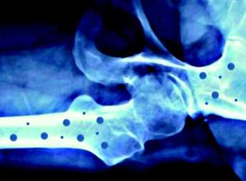 Il 20 ottobre ‘Giornata mondiale dell’osteoporosi’